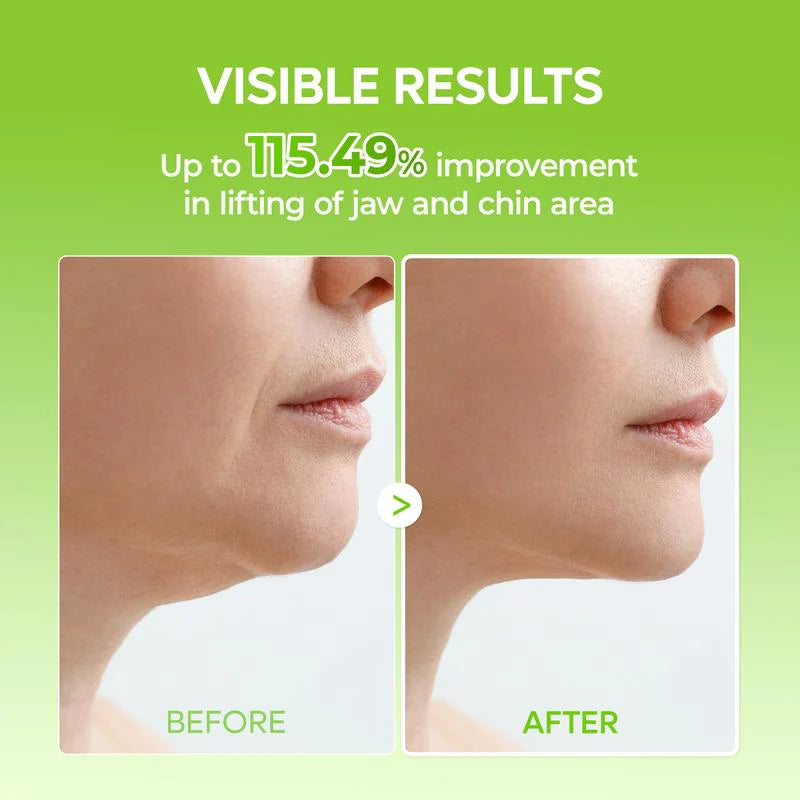 V-Line Lifting-Kinnband (4er-Pack)