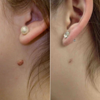 Skin Tag Removal Kit