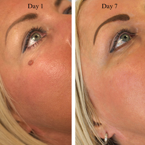Skin Tag Removal Kit