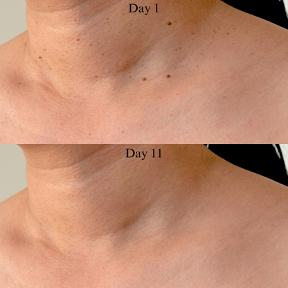 Skin Tag Removal Kit