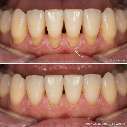 Lindalia CollaGum Gum Rebuild Collagen Powder